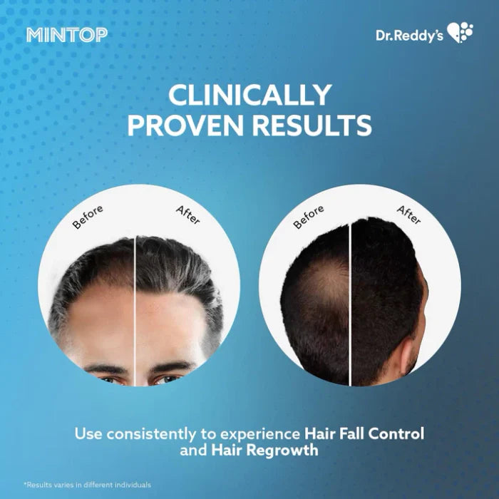 Mintop Forte 5% Hair Solution, 60 ml