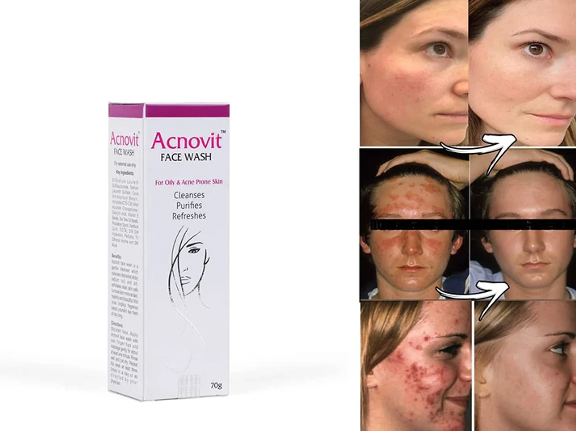 Acnovit facewash for oily & acne prone skin, 70ml